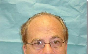 Hair restoration procedure results