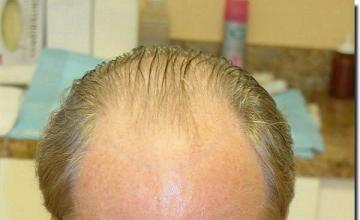 Hair restoration procedure results