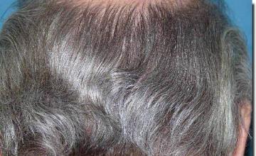 Hair restoration procedure results
