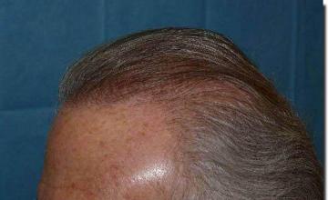 Hair restoration procedure results