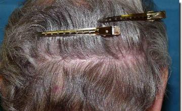 Hair restoration procedure results