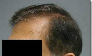 Hair restoration procedure results