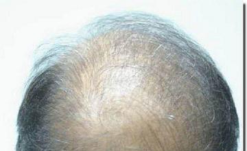 Hair restoration procedure results