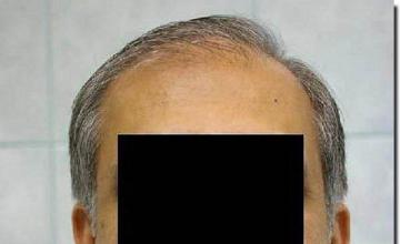 Hair restoration procedure results