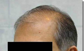 Hair restoration procedure results