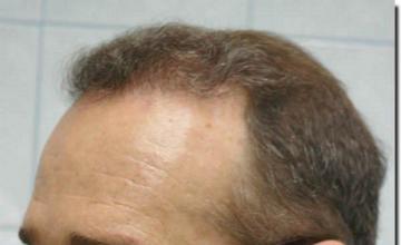 Hair restoration procedure results