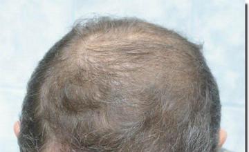 Hair restoration procedure results