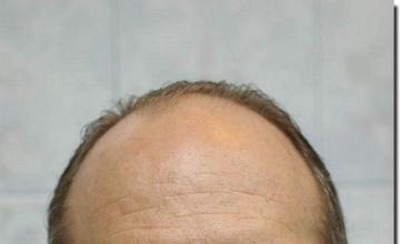 Hair restoration procedure results