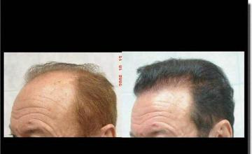 Hair restoration procedure results