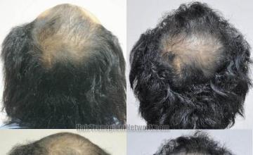 Hair transplantation surgery before and after pictures