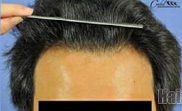 Front view - Hair restoration procedure results