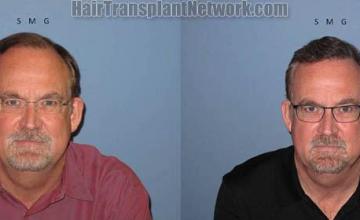Hair transplant photos before and after surgery