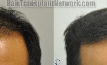 Hair restoration procedure before and after results