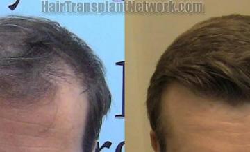 Front view - Before and after  