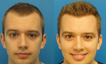 Hair restoration procedure before and after results