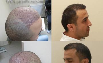 Hair transplantation surgery before and after images