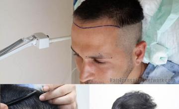 Hair transplant surgery before and after photos