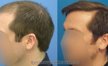 Hair transplantation surgery before and after images