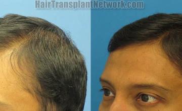 Hair transplantation surgery before and after pictures