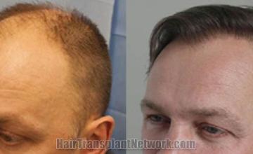  before and after images