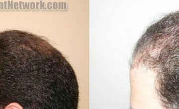 Hair transplantation surgery before and after pictures