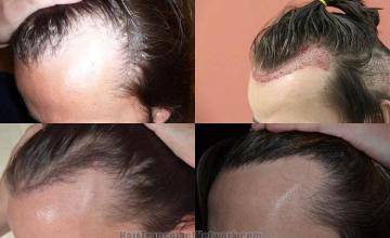 Hair transplantation surgery before and after photos