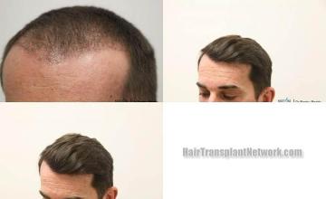 Hair transplantation surgery before and after images