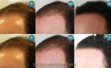 Hair transplantation surgery before and after pictures