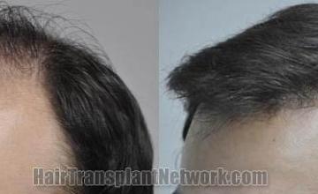 Hair transplantation surgery before and after photos