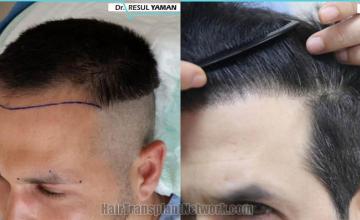 Hair transplantation surgery before and after images