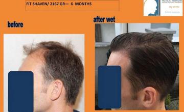 Hair transplantation surgery before and after pictures