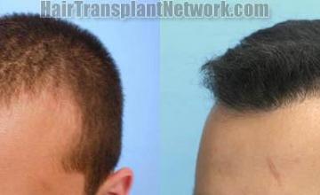 Hair restoration procedure before and after pictures