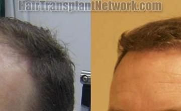 Hair transplantation surgery before and after images