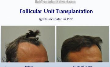 Hair restoration procedure before and after results