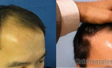 Results from 1742 graft hair replacement procedure