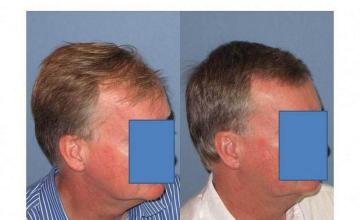 Right side view of before and after hair transplant results