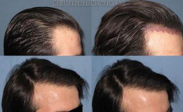 Hair restoration photos viewed from the right