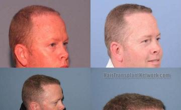 Hair transplantation surgery before and after images