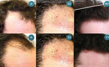 Hair transplantation surgery before and after images