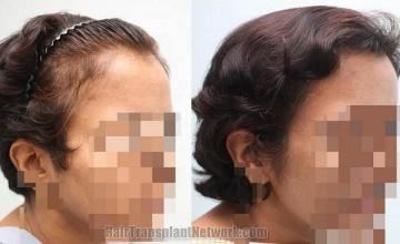 Hair transplantation surgery before and after pictures