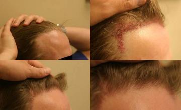 Hair transplantation surgery before and after pictures