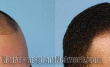 Hair transplantation surgery before and after photos