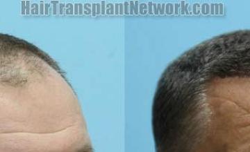 Hair transplantation surgery before and after photos