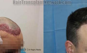 Hair restoration procedure before and after pictures