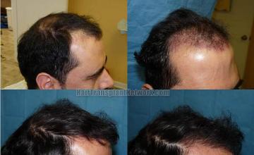 Before and after hair transplantation surgery images