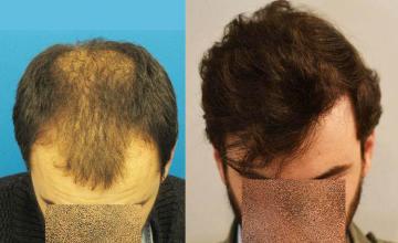 Hair transplantation surgery before and after images