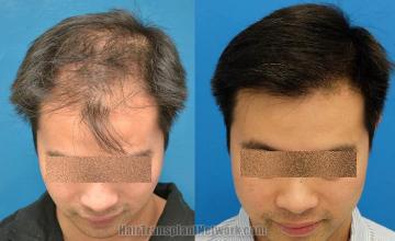 Before and after hair transplantation result photographs