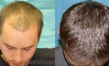 Hair restoration procedure photos - Top view 