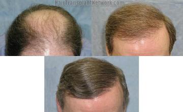  before and after photos