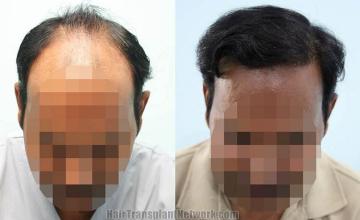 Top view before and after hair restoration results